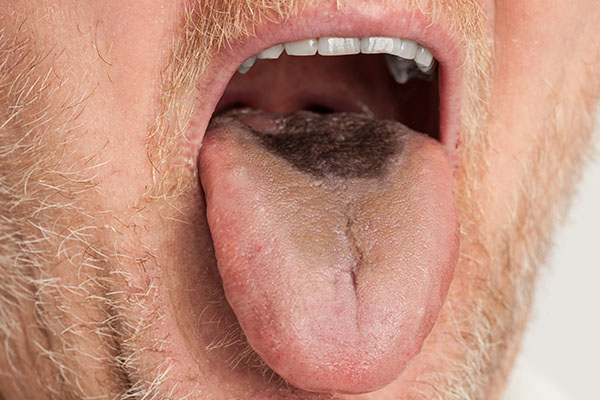 Black-Hairy-Tongue