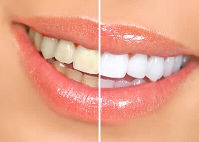 teeth-whitening